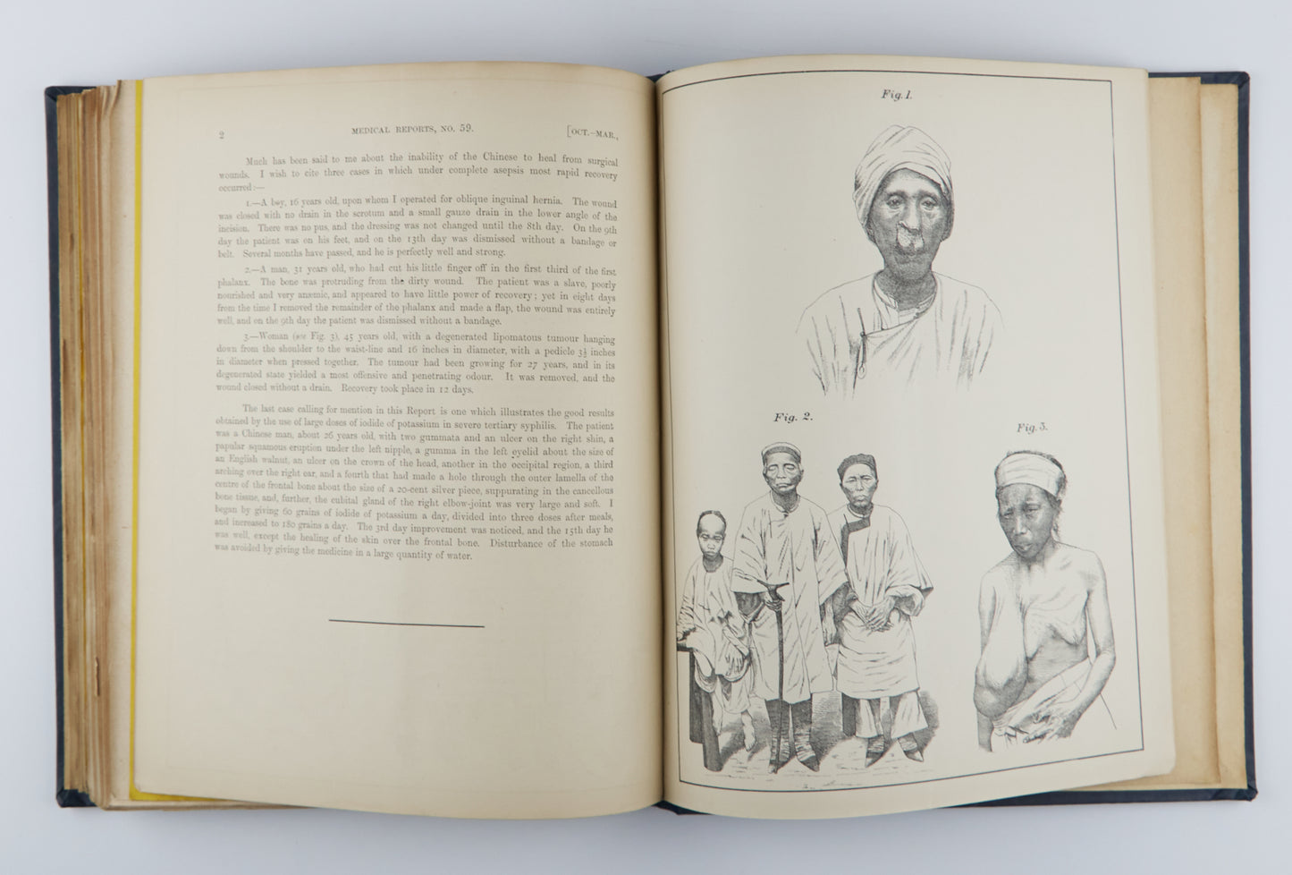 China Imperial Maritime Customs Medical Reports (1893-1904), Issues 45–67, in 3 Volumes